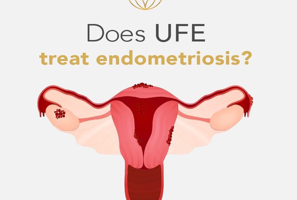 Does UFE treat endometriosis