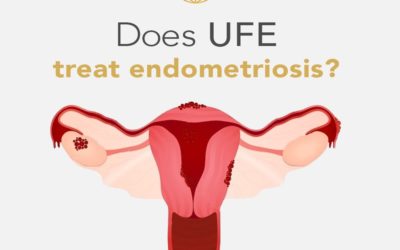 Does UFE treat endometriosis