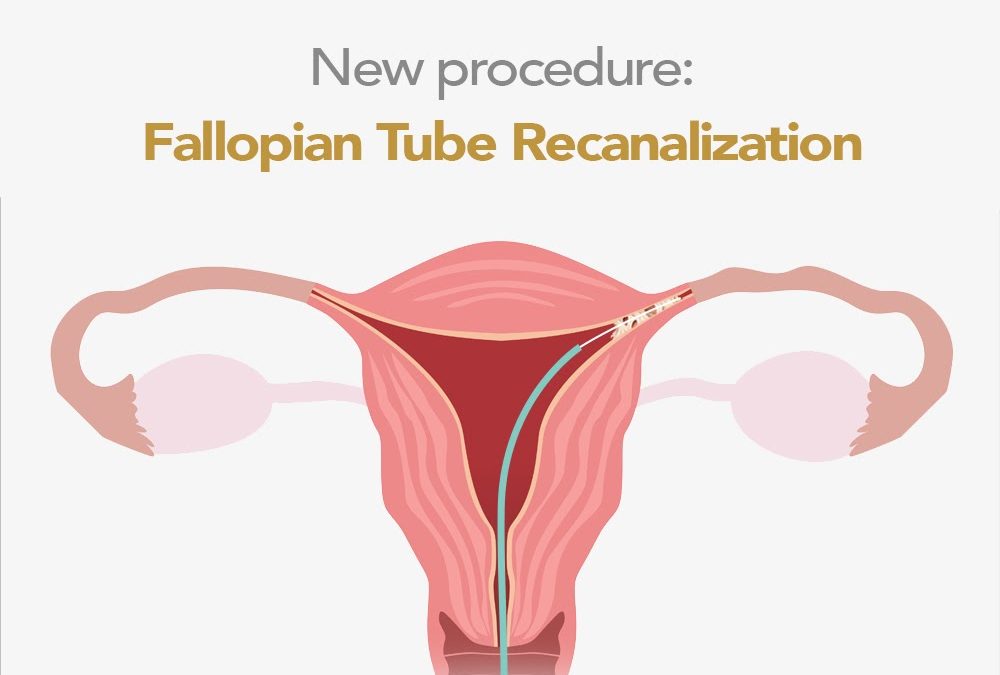 Fallopian Tube Recanalization Fibroid Treatment Clinic