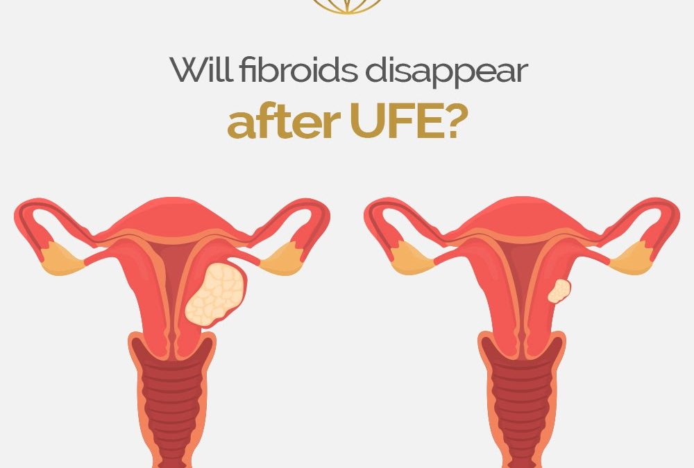 Will fibroids disappear after UFE?