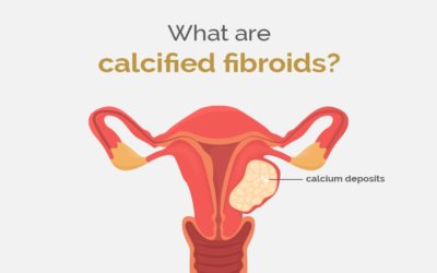 What are calcified fibroids?