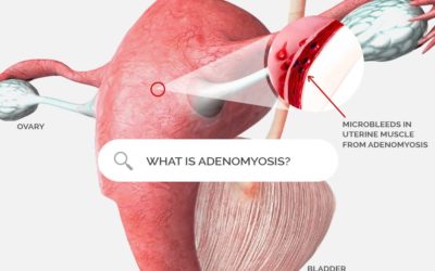 What is adenomyosis?