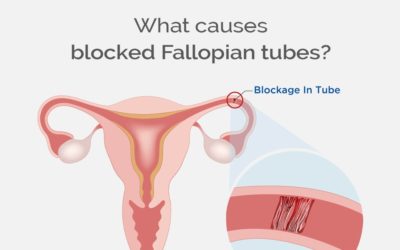 What causes blocked Fallopian tubes?