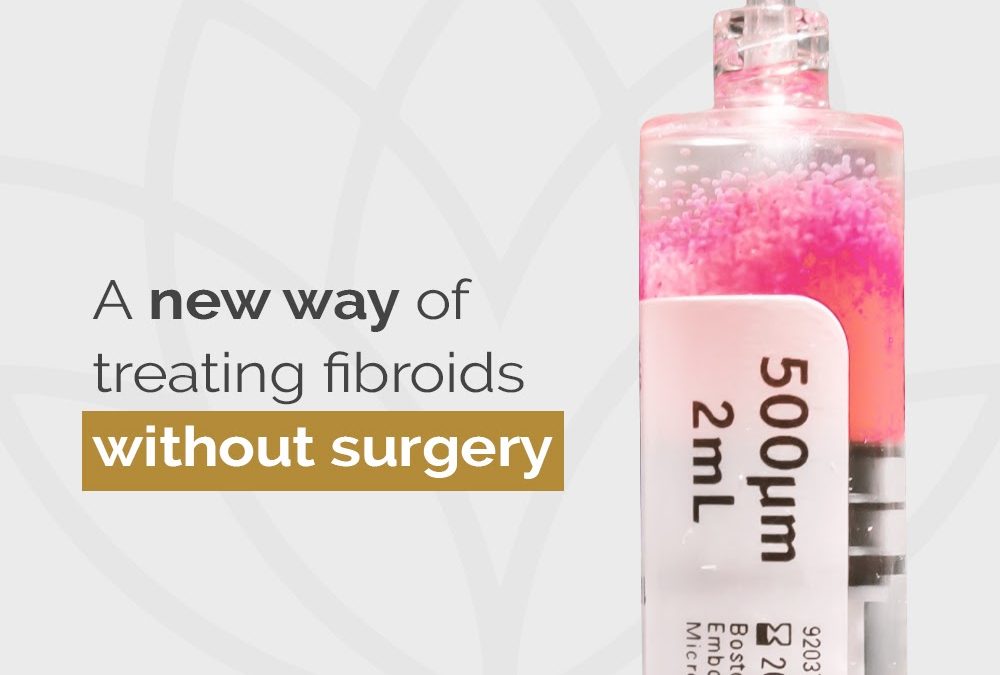 A new way of treating fibroids without surgery