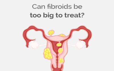 Can fibroids be too big to treat?