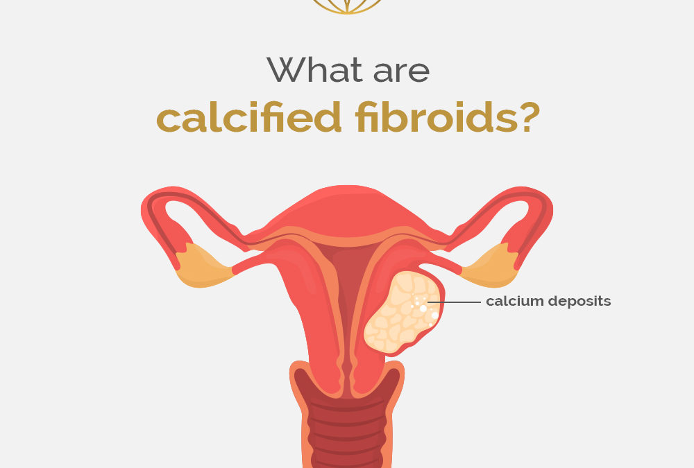 What are calcified fibroids? Fibroid Treatment Clinic