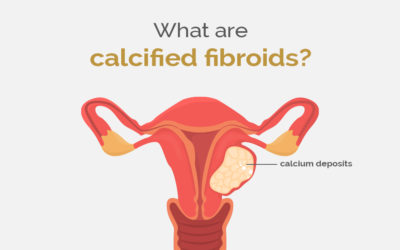 What are calcified fibroids?