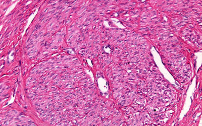 Fibroid images