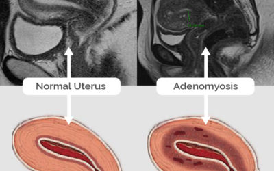 Adenomyosis images