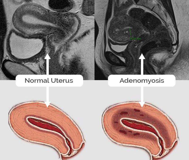 Adenomyosis images