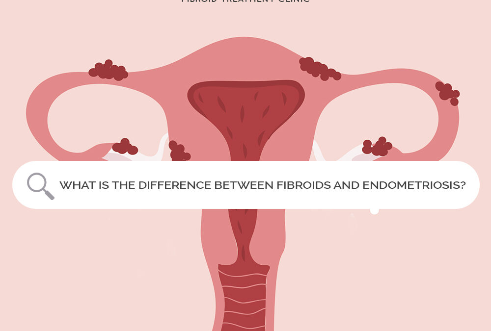 Difference between Fibroids and Endometriosis