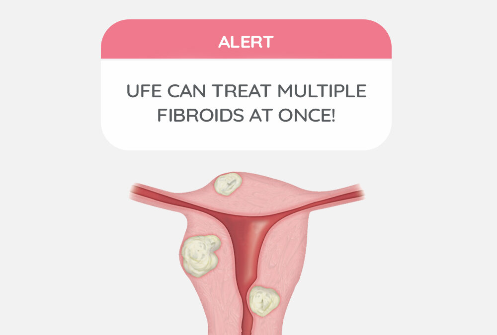 UFE can treat multiple fibroids at once!