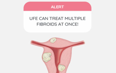 UFE can treat multiple fibroids at once!