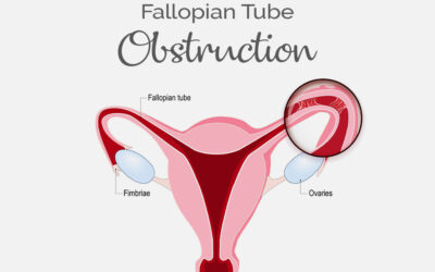 What is the cause of blocked fallopian tubes?