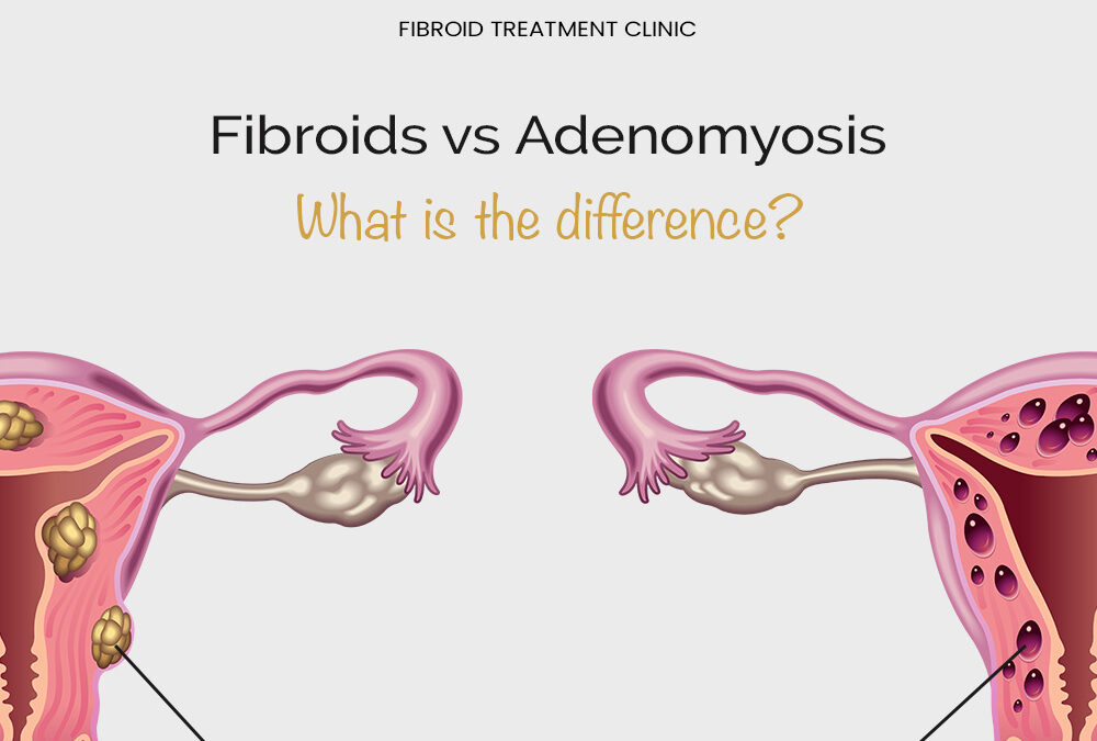 Fibroids vs Adenomyosis