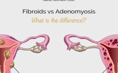 Fibroids vs Adenomyosis