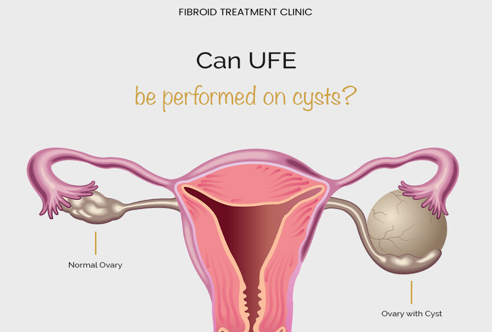 FAQ: Can UFE be performed on cysts?
