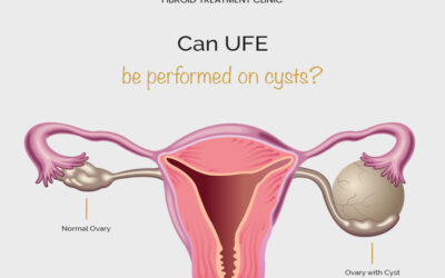 FAQ: Can UFE be performed on cysts?