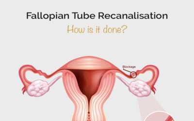 Fallopian Tube Recanalisation: How it’s done