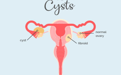 Fibroids vs Cysts