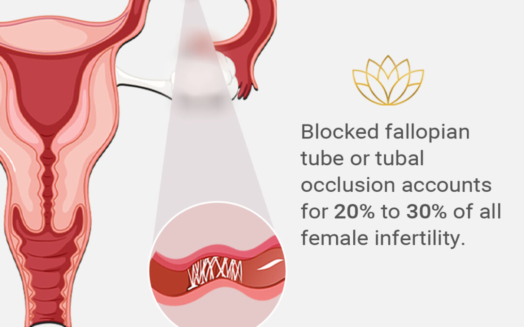 Blocked Fallopian tube or tubal occlusion accounts for 20% to 30% of all female infertility